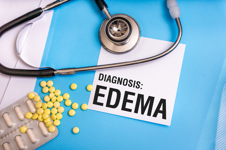 Edema word written on medical blue folder with patient files, pills and stethoscope on backgroundの写真素材