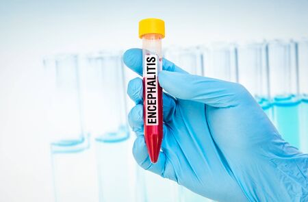 Scientists hand holding a test-tube with blood sample for ENCEPHALITIS testの写真素材