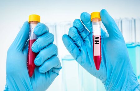 Scientists hand holding a test-tube with blood sample for HIV or AIDS testの写真素材