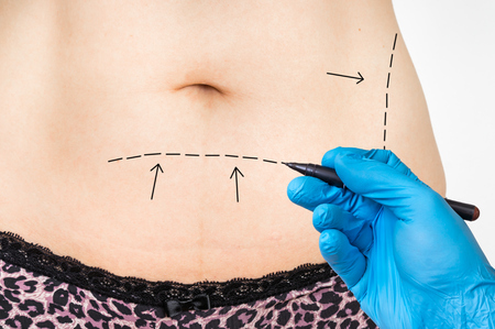 Plastic surgery doctor draw lines on patient belly - cosmetic surgery and liposuction conceptの写真素材
