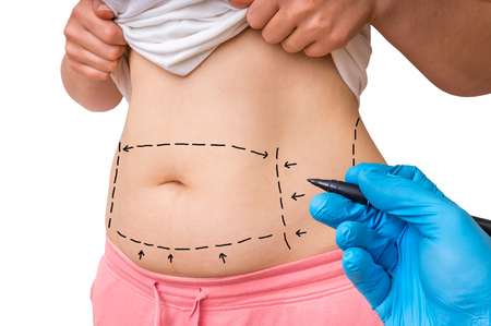 Plastic surgery doctor draw lines with marker on patient belly - isolated on white backgroundの写真素材