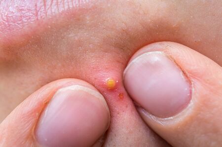 Young woman squeezing pimple with two fingers on her face - acne treatment conceptの写真素材