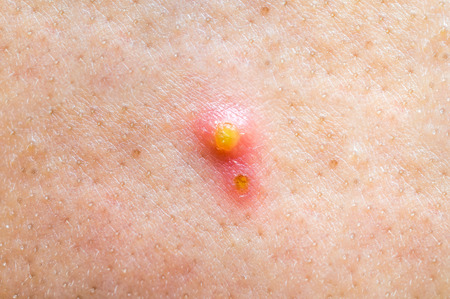 Close-up photo of pimple or acne on face - skin care conceptの写真素材