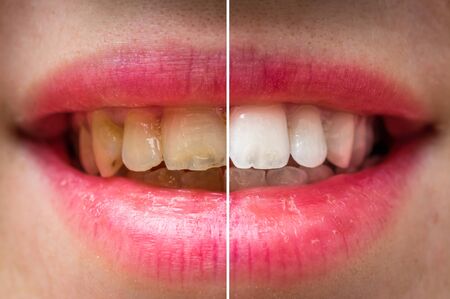 Woman teeth before and after dental treatment - dental health conceptの写真素材