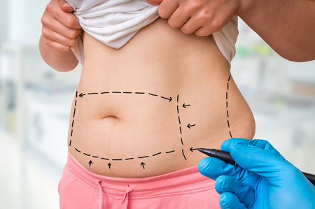 Plastic surgery doctor draw lines with marker on patient belly at clinicの写真素材