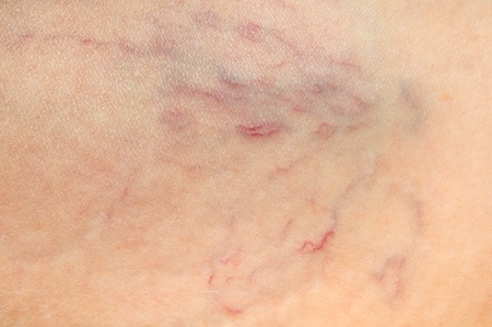 Close-up view of spider veins on female leg - varicose veins conceptの写真素材