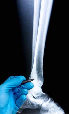 X-ray of human leg with doctor's hand in glove. X-ray image concept.の写真素材