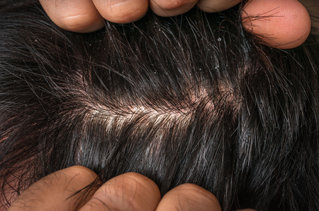 Closeup view of hair of a man with dandruff - psoriasis conceptの写真素材