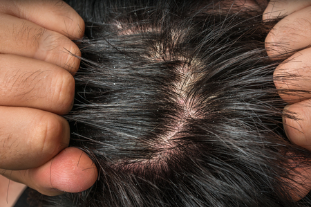 Closeup view of hair of a man with dandruff - psoriasis conceptの写真素材