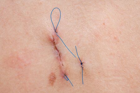 Medical scar with blue thread after surgery operation - surgery conceptの写真素材