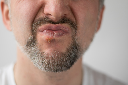 Lower part of beard man's face with herpes on his lips wrincled in unleasantness. Horizontal shot with sides 16 x 9. Face is on the left side and right is for copy space. White background.の写真素材