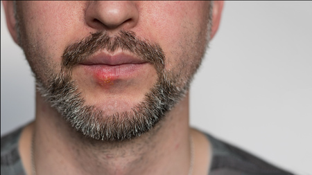 Lower part of beard man's face with herpes on his lips. Horizontal shot with sides 16 x 9. Face is on the left side and right is for copy space. White background.の写真素材