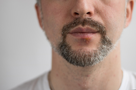 Lower part of beard man's face with herpes on his lips. Horizontal shot with sides 3 x 4. Face is on the righr side and left is for copy space. White background. White T-shirtの写真素材