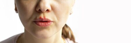 Part of a young woman face with red bubbles of virus herpes on lips Medicine, treatment. Long horizontal banner with copy space Selective focus Close upの写真素材
