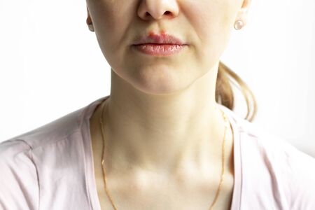 Red bubbles of virus herpes on lips of a woman in light pink t-shirt, lower part face is seen. Medicine, treatment. horizontal banner copy space. White backgroundの写真素材