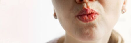 Lower part part of woman face with Red bubbles of virus herpes on her lips, she kisses the air, white background, Zoster, Cold, Medicine, Treatment. Long horizontal banner with copy spaceの写真素材