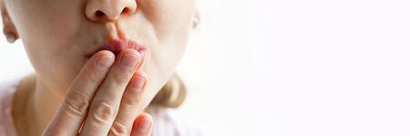 Lower part part of woman face with Red bubbles of virus herpes on her lips, she hides with her palm on white background, Zoster, Cold, Medicine, Treatment. Long horizontal banner with copy spaceの写真素材