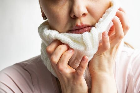 Lower part part of woman face with Red bubbles of virus herpes on her lips, that she tries to hide under white knitted neckwarmer, Zoster, Cold, Medicine, Treatment. Horizontal, winter diseaseの写真素材