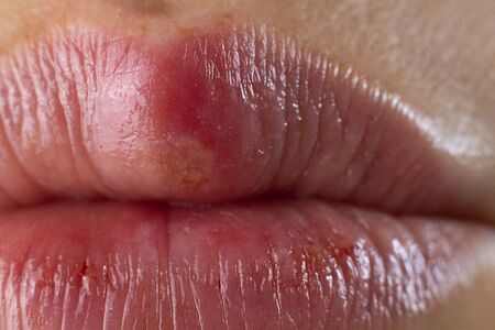 Closeup of Red bubbles of virus herpes on lips. Zoster, Cold, Medicine, Treatment. Horizontal Macro shot. Selective focus.の写真素材