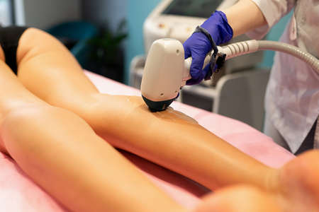 Laser depilation leg hair removal therapyの写真素材