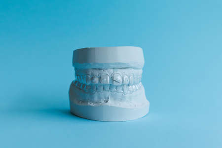 Dental plaster model of human jaw before treatment with bracesの写真素材