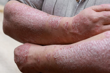 Psoriasis skin with red wounds. Male arms with cracked, hard, horny, flaky skin. Dermatological...