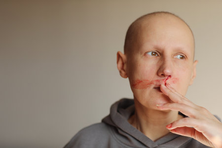 Hairless cancer sick female patient is bleeding from her nose, effects of chemotherapy. Young bald woman lost her eyebrows and eyelashes and has heavy nosebleed with red blood on the faceの写真素材