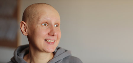 effects of chemotherapy. Portrait of funny faceennial millennial hairless woman having cancer diagnosis looking at side is showing mouth without tooth after radiation treatment. Dental problem, tooth loss.の写真素材