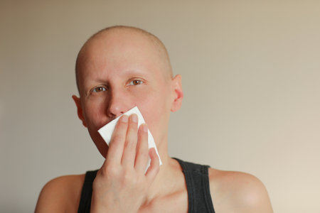 Bald cancer sick woman blowing running nose got flu cough cold, rhinitis sneezing in tissue or nosebleeds. Female is sick allergic having allergy symptoms coughing holding napkin. Misery, infelicity.の写真素材