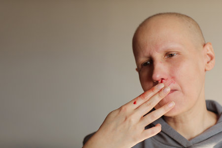 Hairless cancer sick female patient is bleeding from her nose, effects of chemotherapy. Young bald woman lost her eyebrows and eyelashes and has heavy nosebleed with red blood on the faceの写真素材