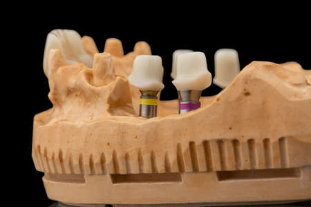 Close-up side view of a dental lower jaw prosthesis on black glass background. Artificial jaw with veneers and crowns. Tooth recovery with implant. Dentistry conceptual photo. Prosthetic dentistry.の写真素材