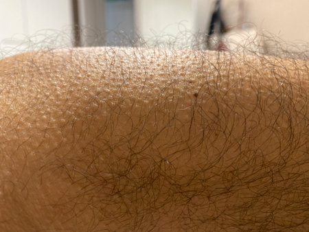 Hair removal on the back of a man. Close-up.の写真素材