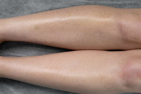 Image before and after concept of hair removal on female legs in a beauty salon.の写真素材