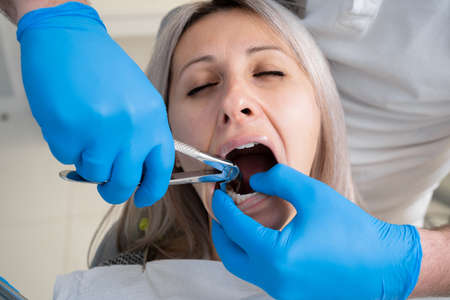 poor girls mouth in the bib of the patient in the dental clinic. A dentist in blue latex gloves removes her tooth with a buccal retractor and forceps.の写真素材