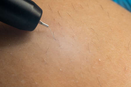 Process of permanent hair removal, removing unwanted hair using an electroepilation device, close-up macroの写真素材