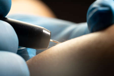 process of permanent unwanted hair removal, using an electroepilation device, close up macro photoの写真素材