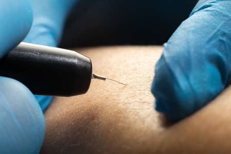 Close up the process of permanent unwanted hair removal, using an electroepilation device.の写真素材