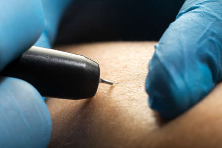 Close up the process of permanent hair removal, using an electroepilation device.の写真素材