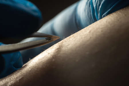 Doctor hair removal specialist, professional electro epilation hair from womans legs with tweezers, close up. Cosmetology procedureの写真素材