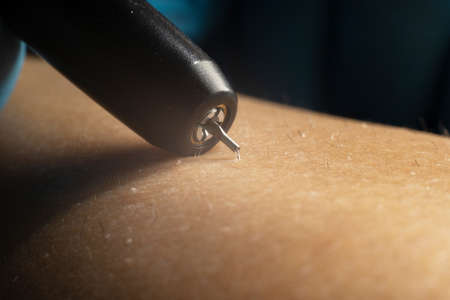 close up process of permanent unwanted hair removal, using an electroepilation device in beauty salon. macroの写真素材