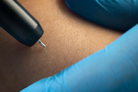 Electrologist removal hair from legs, close up. Electro epilation procedure.の写真素材