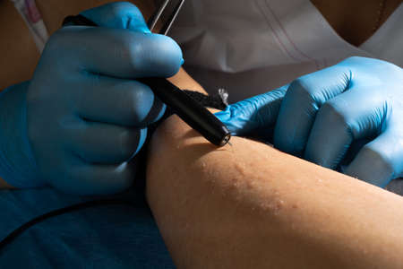 Doctor hair removal specialist, professional electro epilation hair from womans legsの写真素材