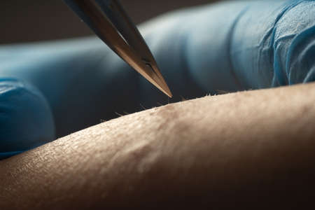 process of permanent hair removal, removing unwanted hair using an tweezers, close-up macro photography.の写真素材