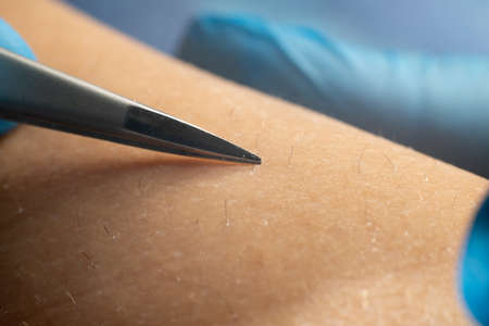 process of permanent hair removal, removing unwanted hair using an tweezers, epilation hair from womans legs, close-up macro photography. Cosmetology procedureの写真素材