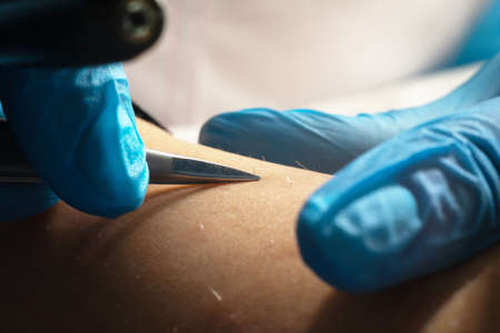 process of hair removal, removing unwanted hair using an electroepilation device and tweezers, close-upの写真素材