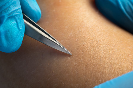 process of permanent hair removal, removing unwanted hair using an tweezers, close-up macro photography. Cosmetology procedure in beautyの写真素材