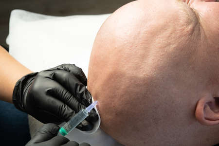Mesotherapy of hair and head. Head injections. Fighting hair loss in men. head of a bald man and hands of a beautician trichologistの写真素材