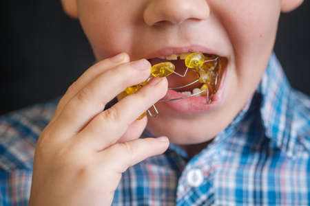 the boy puts a Frenkel device in his mouth to correct the bite. Medicine, orthodontics. Correction of bite in children.の写真素材
