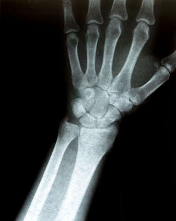 Xray of a wristの写真素材