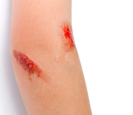 Young Child With Bloody Scrape on Armの写真素材